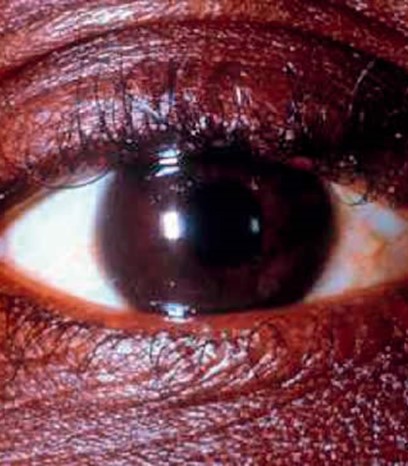 Eye showing signs of glaucoma