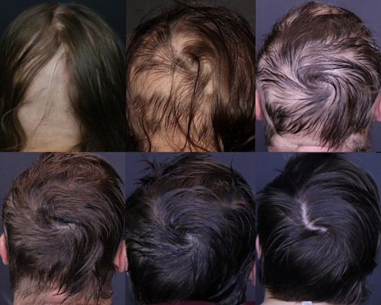 PRP hair Loss Treatment regrowth